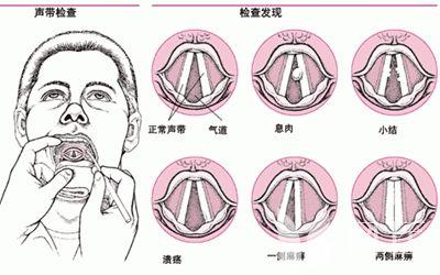 怎么判断声带受损 声带小结的最佳治疗方法