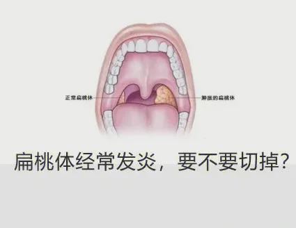 盐水漱口缓解扁桃体发炎有效吗？