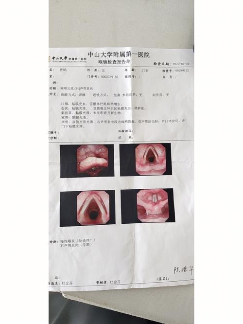 声带息肉切除术后恢复时间及效果揭秘