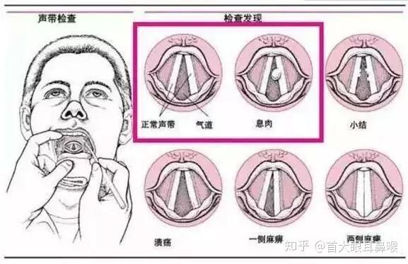 声带受损常见症状及预防措施