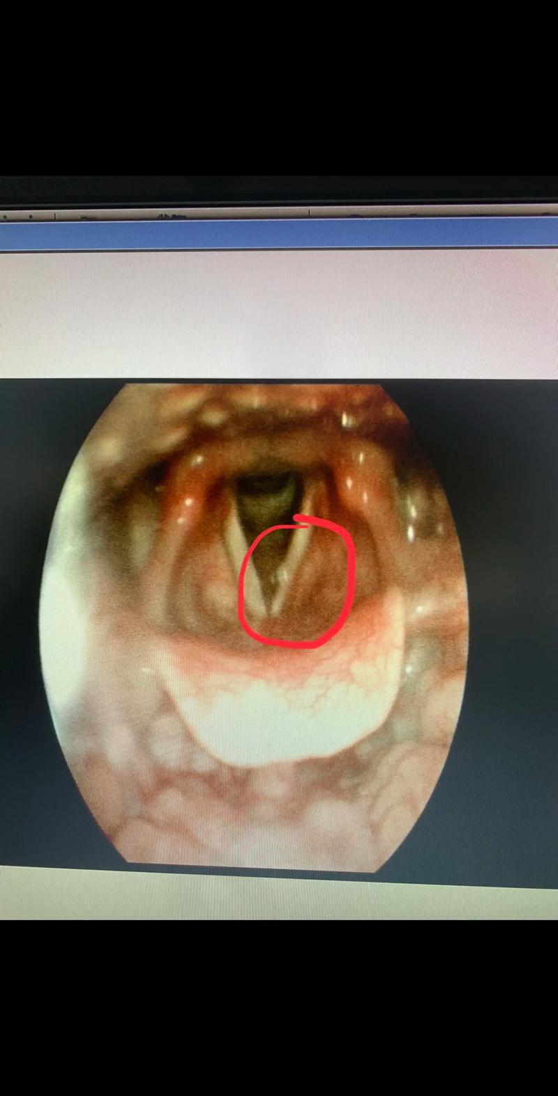 声带息肉：手术还是保守治疗？